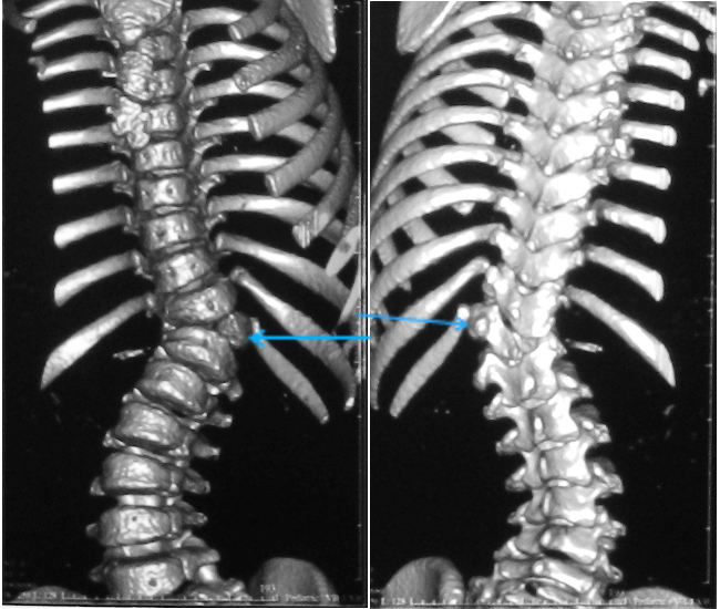 Врожденный сколиоз на фоне полупозвонка