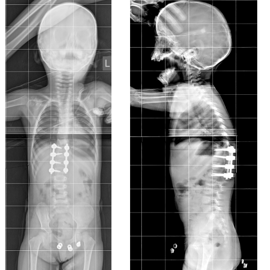 Врожденный сколиоз на фоне полупозвонка